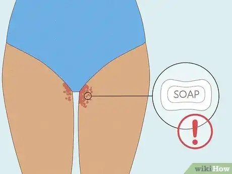 Image intitulée Get Rid of a Rash Between Your Legs Step 9