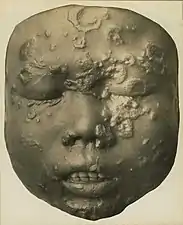 Secondary breakout in a Javanese child age of 12 years. Wax model