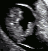 Obstetric ultrasonography of an embryo of 8 weeks with visible heartbeat.