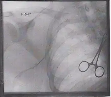 A venogram before catheter-directed thrombolysis for Paget–Schroetter syndrome, a rare and severe arm DVT shown here in a judo practitioner, with highly restricted blood flow shown in the vein