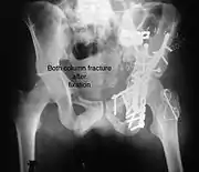 Both column fracture after fixation with screws and plates