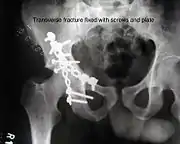 Transverse fracture fixed with screws and plate