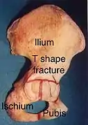 T shape fracture shown on bone model