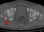 Fracture of the acetabulum