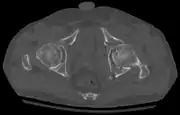 Axial CT image (viewed on bone windows) of a complex comminuted left acetabular fracture involving both anterior and posterior columns.