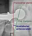 Acetabular anteversion. This parameter is calculated on a lateral radiograph as the angle between the transverse plane and a line going through the (anterior and posterior) margins of the acetabular cup.