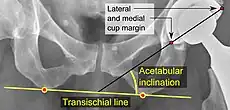 Acetabular inclination. This parameter is calculated on an anteroposterior radiograph as the angle between a line through the lateral and medial margins of the acetabular cup and the transischial line which is tangential to the inferior margins of the ischium bones.