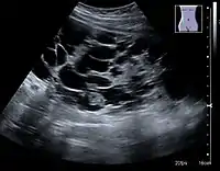 Figure 7. Advanced polycystic kidney disease with multiple cysts.