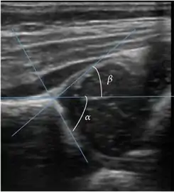 Useful ultrasound measures in neonatal hip sonography, alpha and beta angles.