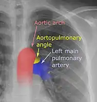On a posteroanterior chest radiograph like this one, the left margin of the aortopulmonary space is normally seen as the "aortopulmonary angle".