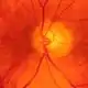 Color fundus picture