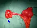 Mucinous adenocarcinoma of the appendix tip