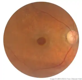 A macular Hole