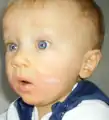 A child with atopic dermatitis