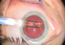 The lens can be seen protruding from the nozzle tip through the pupil as it is ejected