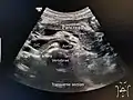 A normal pancreas on ultrasound.