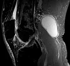 Baker's cyst on MRI, sagittal image