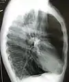 A lateral chest X-ray of a person with emphysema, displaying barrel chest and flat diaphragm.