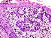Basal cell carcinoma of the skin, cell nuclei (blue-purple), extracellular material (pink).