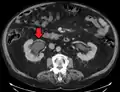 CT scan of bilateral hydronephrosis due to a bladder cancer
