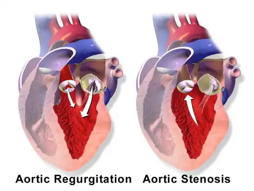 Aortic valve regurgitation vs aortic valve stenosis