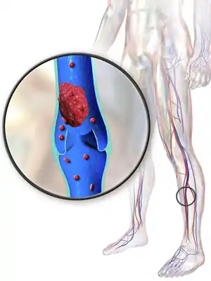 Artistic rendering of DVT