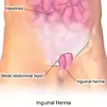 Illustration of an inguinal hernia.