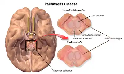 Degradation of substantia nigra associated with Parkinson's disease.