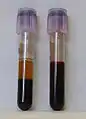 Two tubes of EDTA-anticoagulated blood. Left tube: after standing, the RBCs have settled at the bottom of the tube. Right tube: Freshly drawn blood