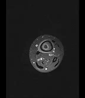 Axial T1-weighted fat-saturated MRI image following IV gadolinium contrast demonstrating the intramedullary lytic area seen on radiography to be ring enhancing consistent with a purulent fluid collection.  Extensive circumferential periosteal enhancement is noted.  There is also substantial bone marrow enhancement.