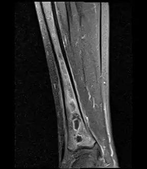 Sagittal T1-weighted fat-suppressed post gadolinium image showing the extent of the multiloculated intramedullary abscess.