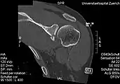 CT scan showing a bony Bankart lesion at the antero-inferior glenoid