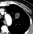 Low attenuating nodule (in this case a fat containing hamartoma).