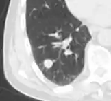 Round well-delineated solid lung nodule with smooth border.
