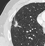 Spiculated lung nodule.