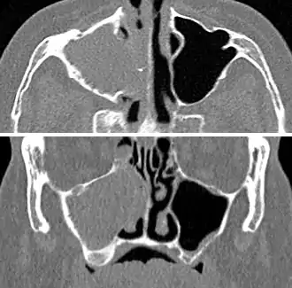 CT scan of chronic sinusitis, showing a filled right maxillary sinus with sclerotic thickened bone.