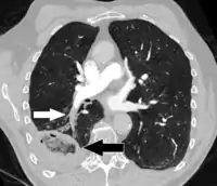 CT scan of a lung infarction because of chronic pulmonary embolism (white arrow). The infarcted area (black arrow) has a reverse halo sign.