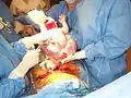 Complete extraction of newborn out of the womb