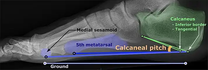 Weight-bearing lateral X-ray showing the measurement of calcaneal pitch, which is an angle of the calcaneus and the inferior aspect of the foot, with different sources giving different reference points. Calcaneal pitch is increased in pes cavus, with cutoffs ranging from 20° to 32°.