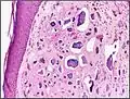 Histopathology of calcinosis cutis in human tissue