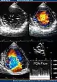 Transthoracic two-dimensional study with color and continuous wave Doppler shows left ventricular noncompaction associated with patent ductus arteriosus (PDA).