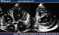 Transthoracic two-dimensional echocardiogram in apical four chamber and parasternal short axis at the level of both ventricles demonstrate dilatation, deep trabeculae and intertrabecular recesses in the inferior, lateral, anterior walls, middle and apical portions of the septum and apex of the left ventricle.