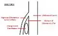 A diagram of a compressed duodenum due to a reduced mesenteric angle.