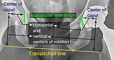 Center of rotation: The horizontal center of rotation is calculated as the distance between the acetabular teardrop and the center of the head (or caput) of the prosthesis and/or the native femoral head on the contralateral side. The vertical center of rotation instead uses the transischial line for reference. The parameter should be equal on both sides.