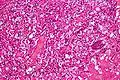 Micrograph of cerebellar hemangioblastoma. HPS stain.
