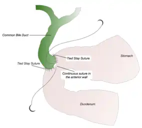 Anterior Wall Anastomosis