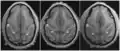 Transverse sections of brains of vervet monkey. It showing difference of the relative position of the left and right ascending ramus of the cingulate sulcus.