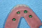 lower denture implant housing