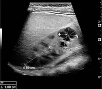 Figure 6. Complex cyst with thickened walls and membranes in the lower pole of an adult kidney. Measurements of kidney length and the complex cyst on the US image are illustrated by '+' and dashed lines.