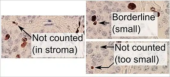 Counting positive versus negative nuclei with Ki-67 labeling, in this case in a neuroendocrine tumor of the small intestine. To count as positive, a nucleus should be at least half within the field of view, be large enough, and not be located in the stroma. Otherwise, even weakly positive nuclei count as positive.